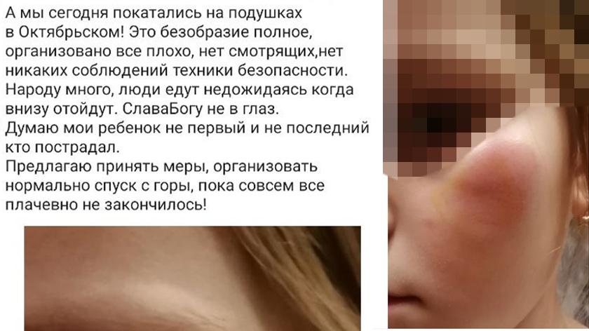 «Полное безобразие!»: на Ямале ребёнок едва не лишился глаза во время похода на горку